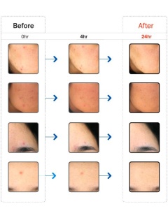 CLEANE® Light Therapy: traitement de l'acnée